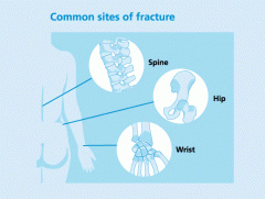 osteoporosis fracture sites